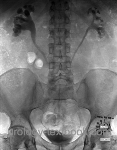 figure Intravenous urography in retroperitoneal fibrosis: medial displacement of both ureters with hydronephrosis