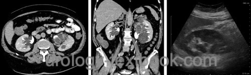 figures Bilateral parapelvic cysts (abdominal CT left and center figure, ultrasound imaging of the same patient right)