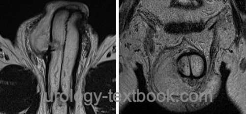 Figure MRI of a penile fracture