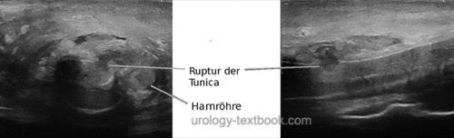 Figure Ultrasond diagnosis of a penile fracture