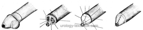 fig. surgical technique of partial penectomy