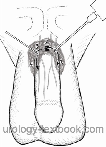 figure Penile nerve block: distal ring block using two injection sites.