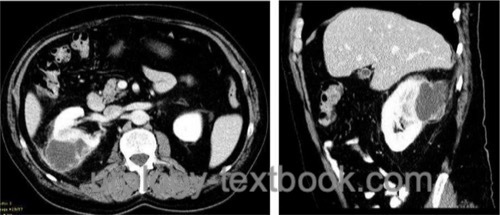 Abb. CT of a right-sided perinephric abscess
