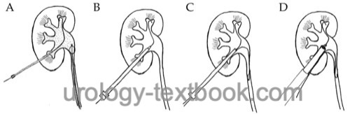 figure Schematic illustration of the percutaneous access for PNL