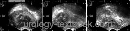 fig. prostatic abscess