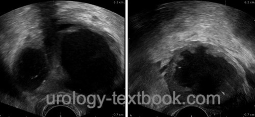 Transrectal ultrasound views showing a prostatic abscess in both lateral lobes