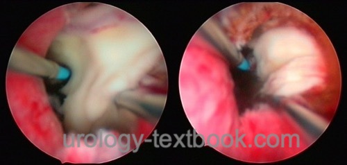 Drainage of a prostatic abscess by transurethral resection