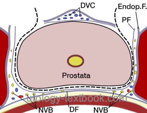 figure: Intrafascial technique of nerve sparing during prostatectomy: the layer directly on the prostate capsule is sought, it is necessary to opening the prostatic fascia and the visceral sheet of the endopelvic fascia ventrally next to the venous plexus.