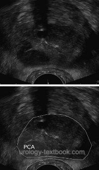 Abbildung TRUS eines Prostatakarzinoms