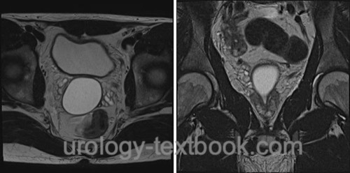 fig. prostatic cyst in transrectal ultrasound