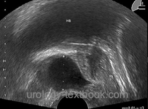 fig. prostatic cyst in transrectal ultrasound