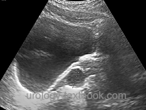 fig. prostatic cyst in abdominal ultrasound imaging