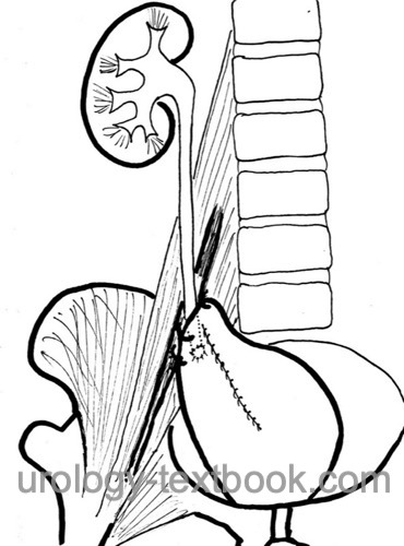 figure Psoas hitch ureteral reimplantation.