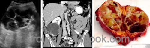 figure Ultrasound imaging, CT and macroscopic findings of a large cystic renal cell carcinoma (pT2b G2)