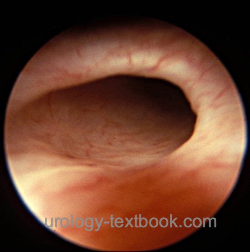 figure Ureteral orifice with reflux (golf hole) in cystoscopy