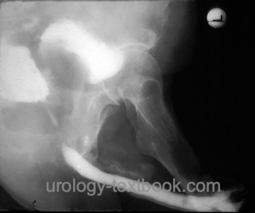 figure: Retrograde urethrography of a rectourethral fistula after radical prostatectomy