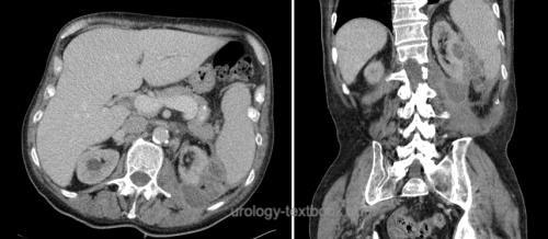 figure: CT of a septated left-sided renal abscess with air inclusions.