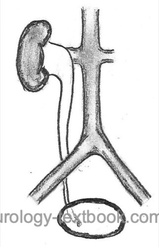 fig. Schematic drawing of a retroiliac ureter