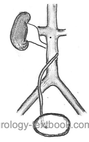 fig. Schematic drawing of a retrocaval ureter