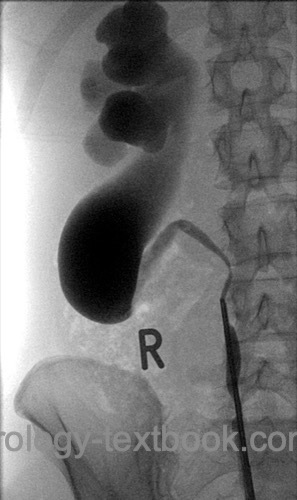 fig. retrocaval ureter in retrograde pyelography