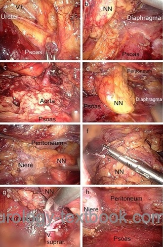 retroperitoneoscopic laparoscopic adrenalectomy for an adrenal tumor