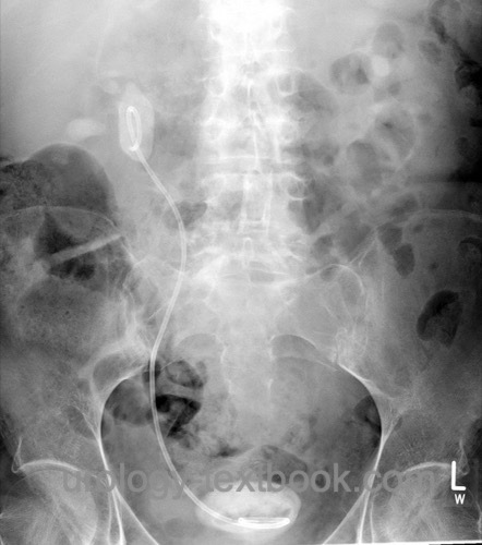 figure forgotten DJ ureteral stent with massive stone formation in the renal pelvis and urinary bladder