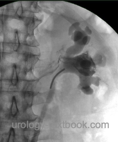 figure Retrograde pyelography with chronic hydronephrosis and pyelolymphatic reflux.