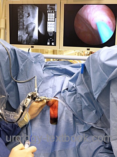 figure Retrograde pyelography with video cystoscopy and digital fluoroscopy