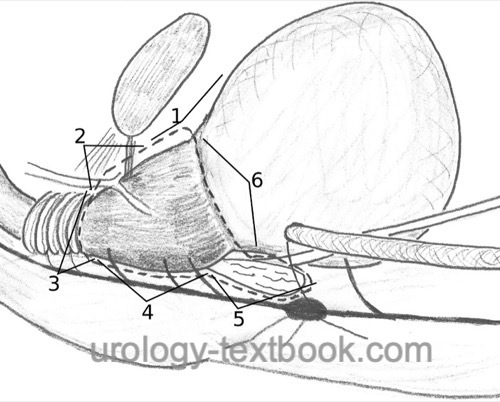 figure: Principles of radical retropubic prostatectomy development of the retropubic space and exposure of the prostate (1), transection of the puboprostatic ligaments and the santorini plexus (2), transection of the urethra (3), ascending dissection of the prostate (4), dissection of the seminal vesicles (5), urinary bladder neck dissection (6)