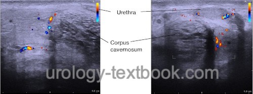 fig. Perineal Dopplersonography of a partial thrombosis of the corpus cavernosum