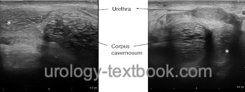 fig. Perineal ultrasound imaging of a partial thrombosis of the corpus cavernosum