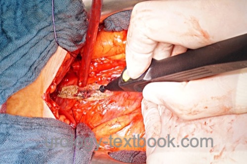 figure surgical procedures in urology