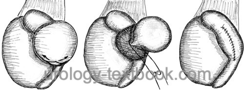 figure Schematic illustration of spermatocelectomy