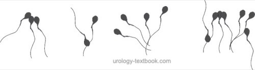 figure different forms of sperm agglutination