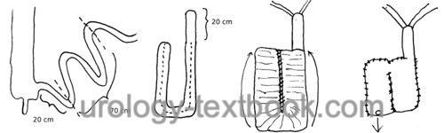 figure ileum neobladder (Studer technique)