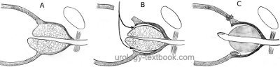 figure: surgical principle of suprapubic transvesical prostatectomy for BPH