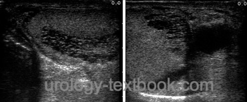 figure tubular ectasia of the rete testis (TERT) in ultrasound imaging of the testis