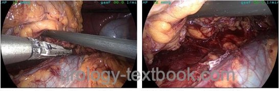 figure  laparoscopic nephrectomy transection of renal vein with a stapler