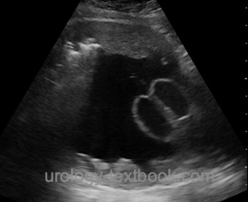 fig. Ultrasound imaging of bladder with detrusor thickening