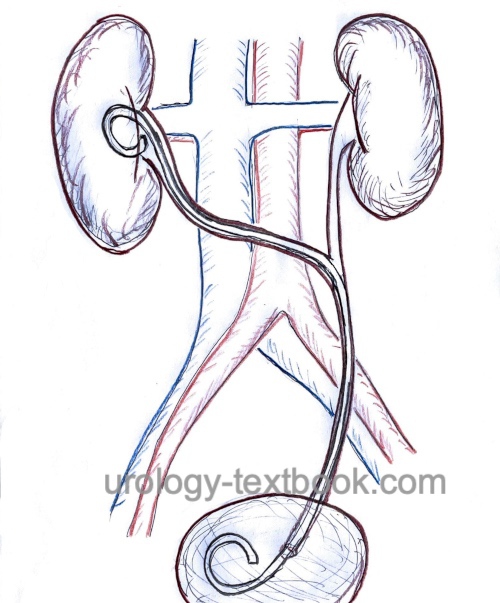 fig. Transureteroureterostomy: the diseased ureter is anastomosed end-to-side with the healthy ureter on the opposite side.