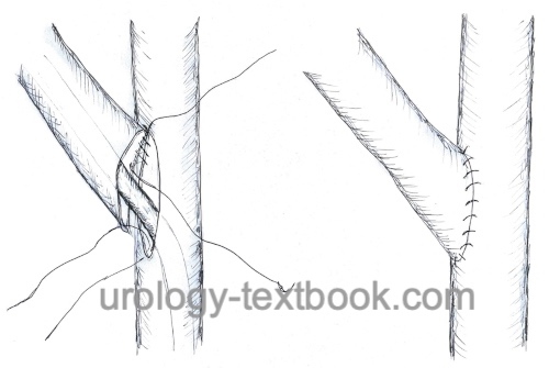 fig. Transureteroureterostomy: the posterior wall of the anastomosis is sutured in a running fashion from the inside and the anterior wall of the anastomosis is sutured from the outside.