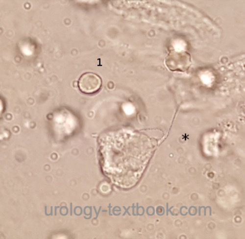 figure Trichomonas vaginalis in urine sediment
