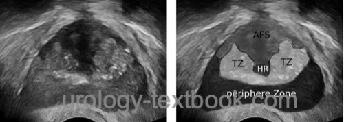 figure Transrectal ultrasonography of the prostate:  prostate zones are visible