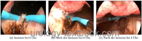 figure TUIP: transurethral incision of the prostate.
