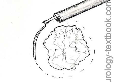 figure En-bloc bladder tumor resection: Circular incision into the tunica muscularis.