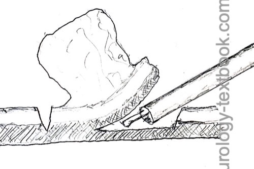 figure En-bloc bladder tumor resection: The tumor base is dissected out of the muscularis.