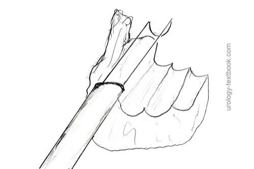 figure Standard bladder tumor resection 1: The bladder tumor is resected with the resection loop from top to bottom