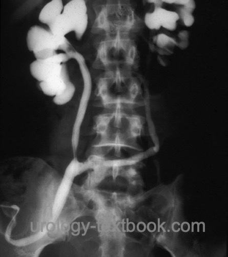 figure ureterocutaneostomy: imaging with retrograde pyelography.