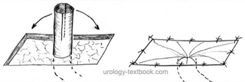 figure ureterocutaneostomy: Toyoda stoma technique