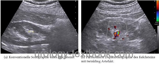 figure Conventional ultrasound imaging of a calyceal kidney stone (left) and with twinkling artifact (right)